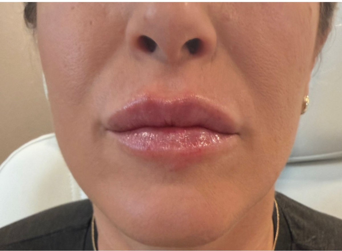 Immediate — lip enhancement