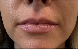 Before — lip enhancement
