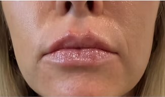Immediate — lip enhancement