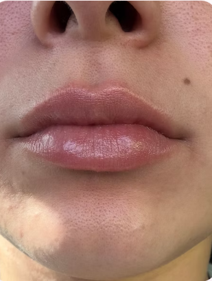 Lip Enhancement