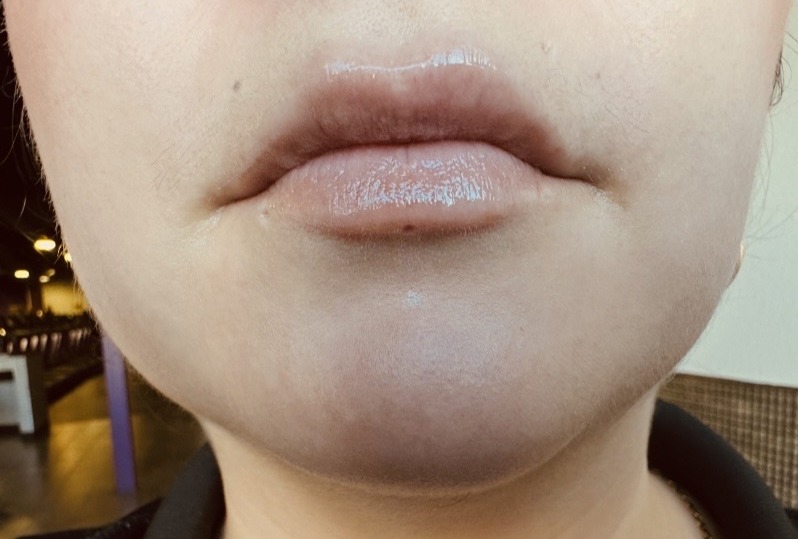 Lip Enhancement